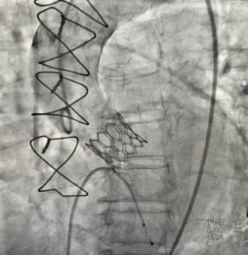 TAVI service image